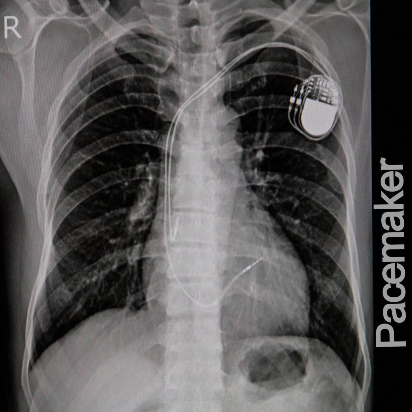 Релиз Pacemaker
