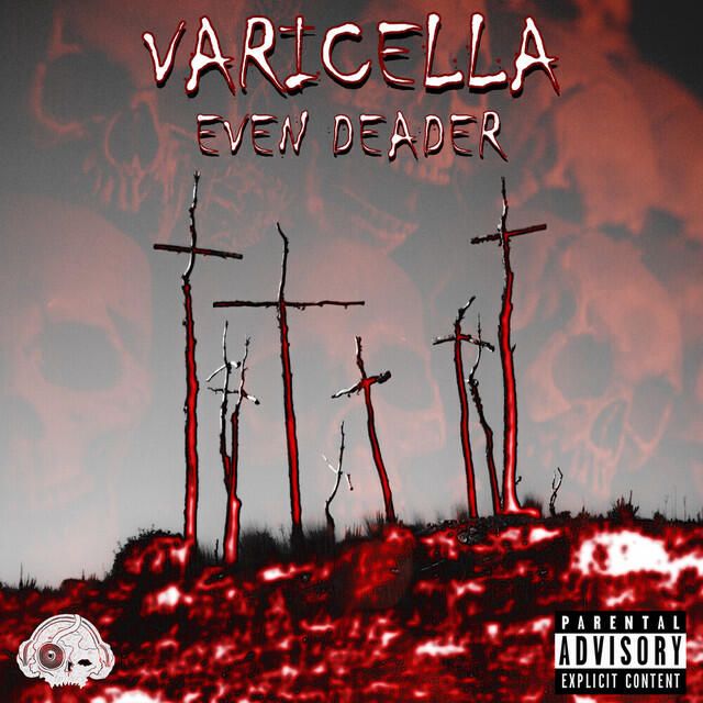 Varicella