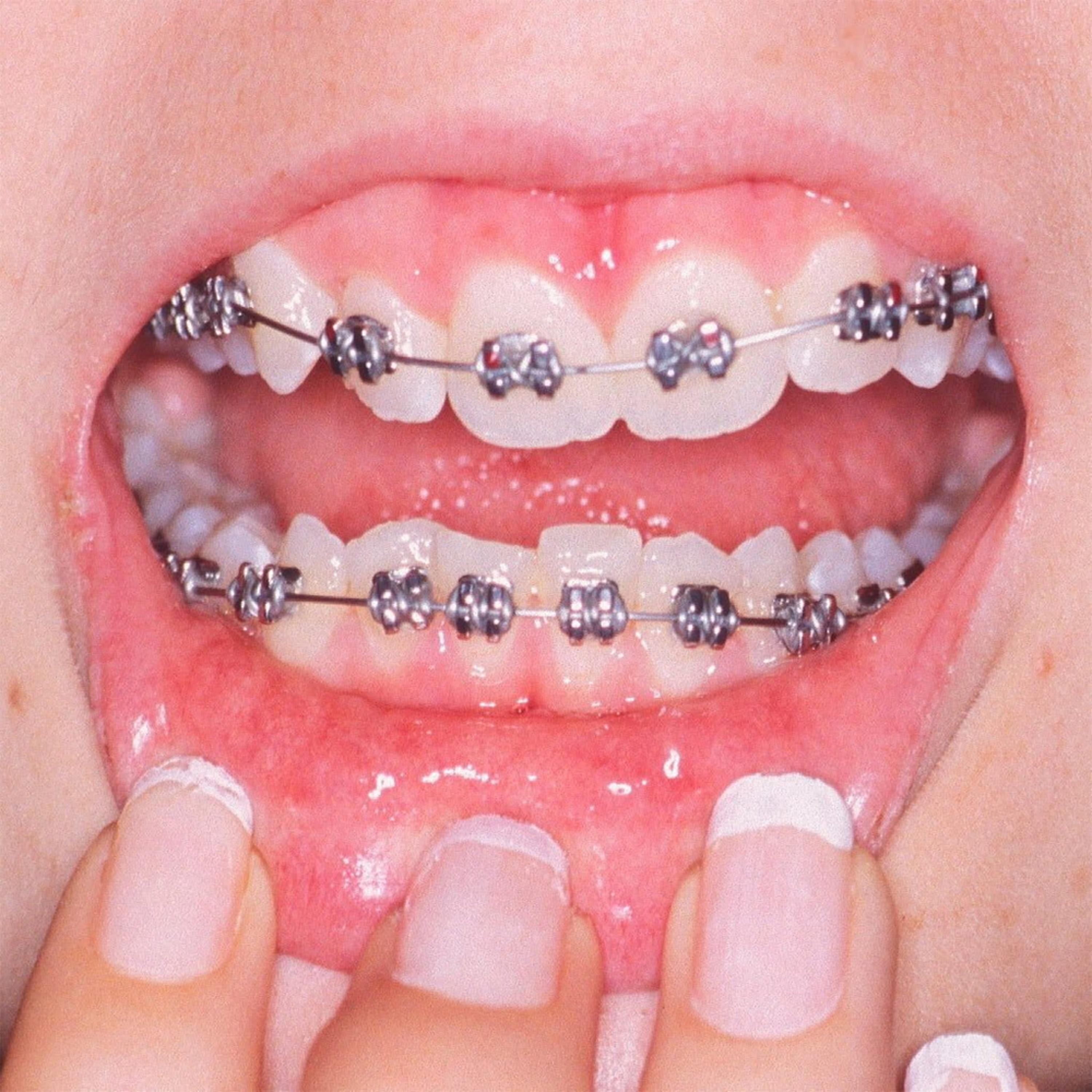 Релиз Teeth