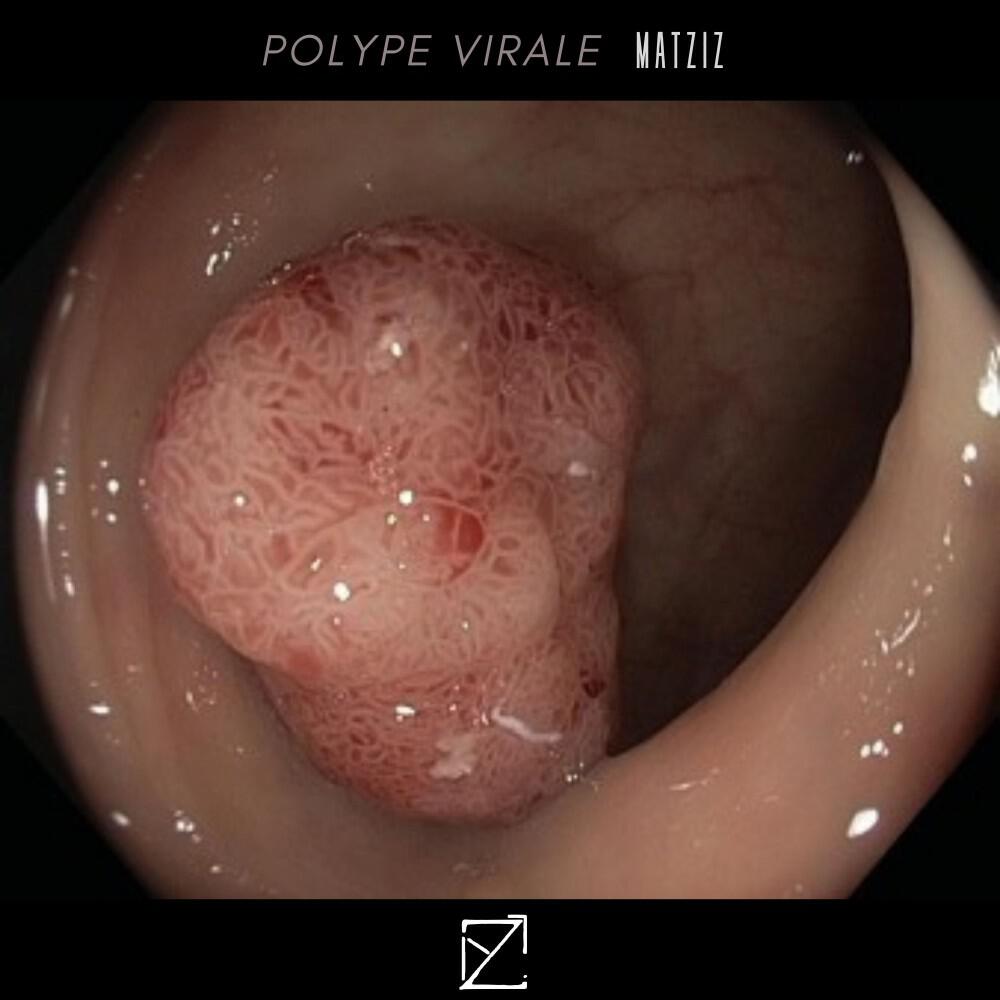 Релиз Polype Virale