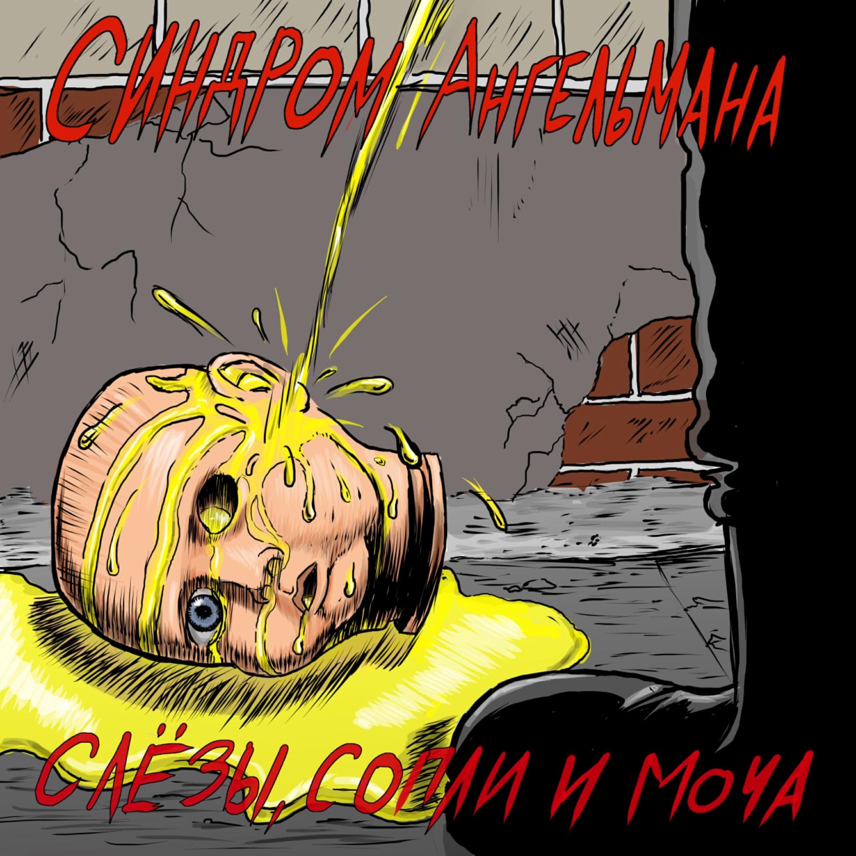 Синдром Ангельмана